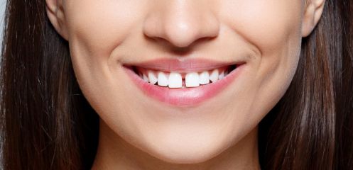 Gaps affecting chewing or speech
